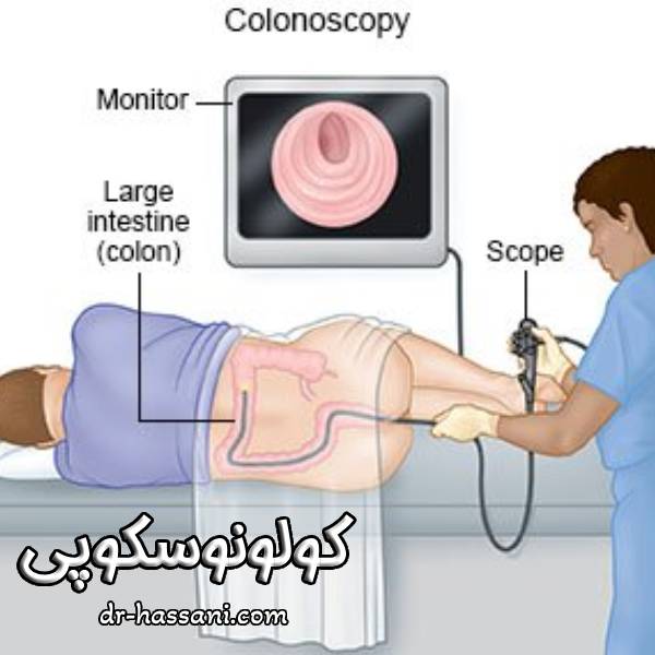 کولونوسکوپی