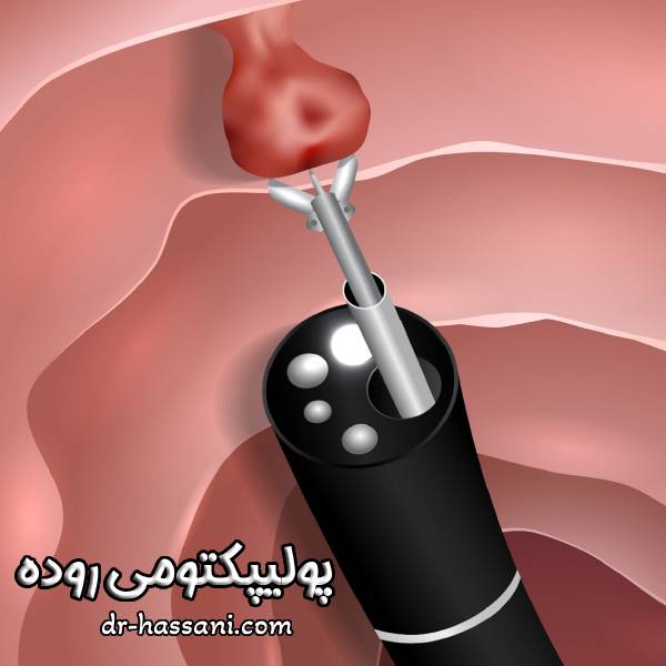 پولیپکتومی روده